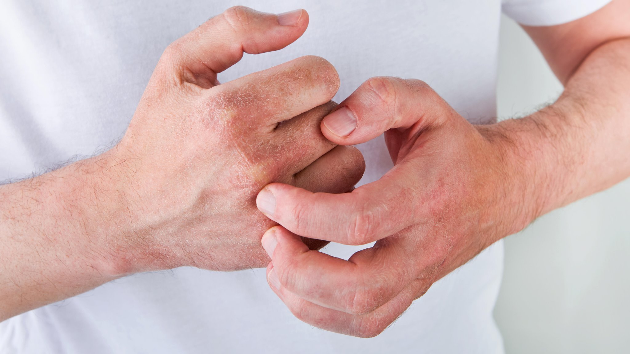 Mann kratzt sich an roten schuppigen Flecken an den Händen.