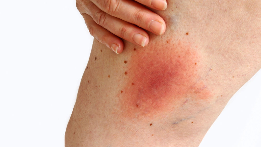 Ein Oberschenkel mit einem großen roten Hautfleck - der sogenannten Wanderröte bei Borreliose.