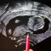 "Ihr Kind wird nicht gesund" – Warum zwei Mütter trotzdem nicht abgetrieben haben | Bild: picture alliance/dpa | Jan Woitas