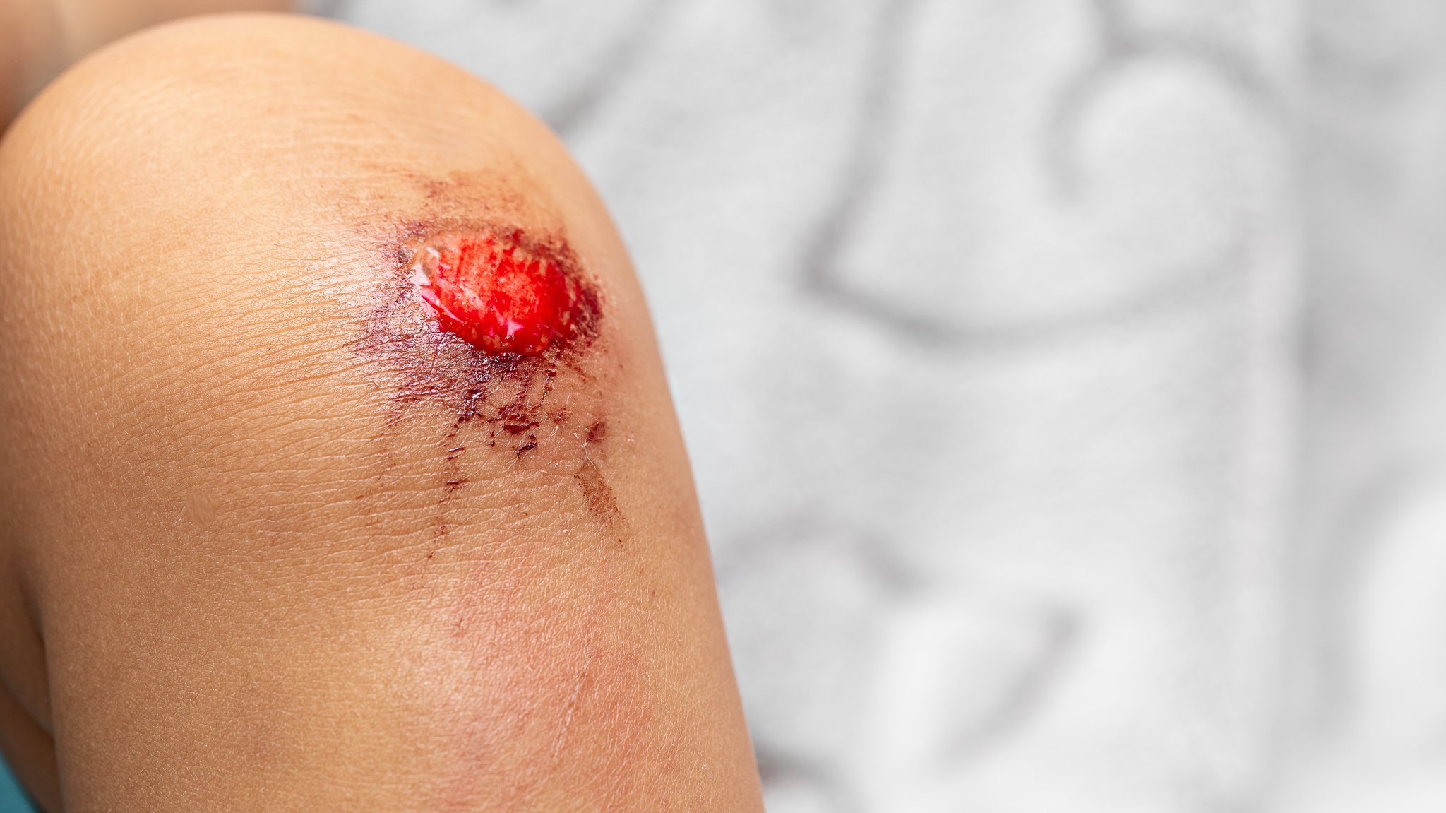 Lebensgefahr durch Sepsis: Wie erkennt man eine Blutvergiftung?