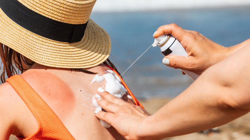 (Symbolbild) Frauenhände sprühen Sonnencreme auf den Rücken eines Kindes, auf dem schon ein Sonnenbrand zu erkennen ist. | Bild: picture alliance / Zoonar | Photographer: Dmitry Naumov (Symbolbild) Frauenhände sprühen Sonnencreme auf den Rücken eines Kindes, auf dem schon ein Sonnenbrand zu erkennen ist.