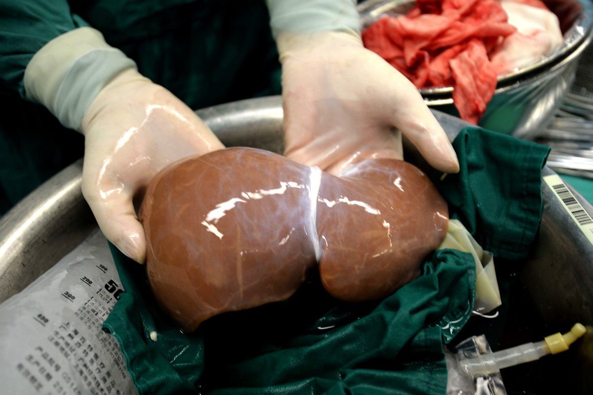 Organtransplantation - Von Machbarkeit und Ethik