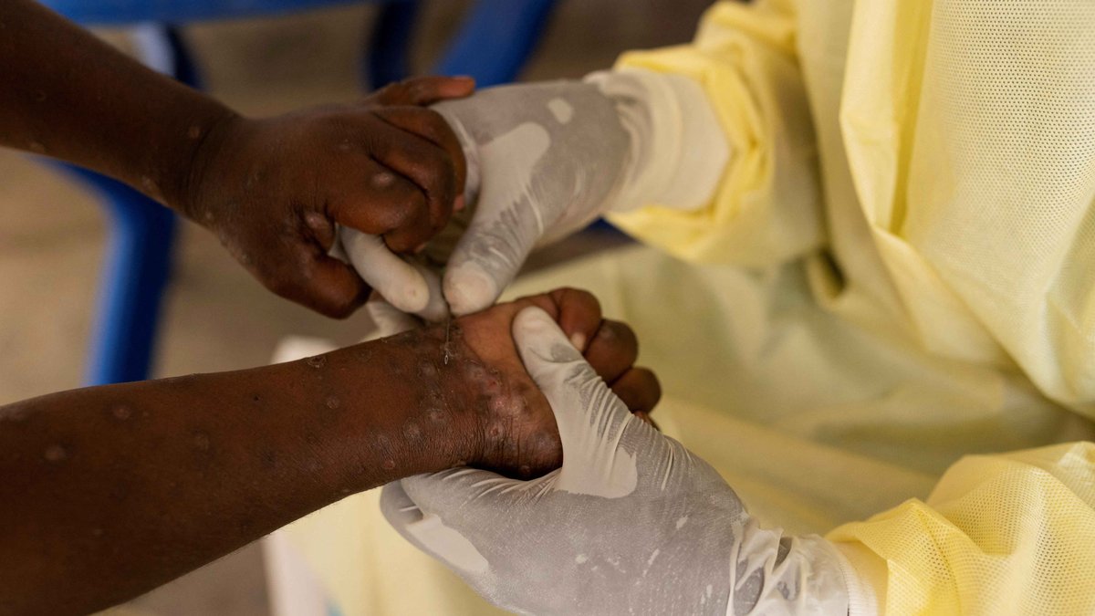 Mpox Patient im Kongo wird untersucht