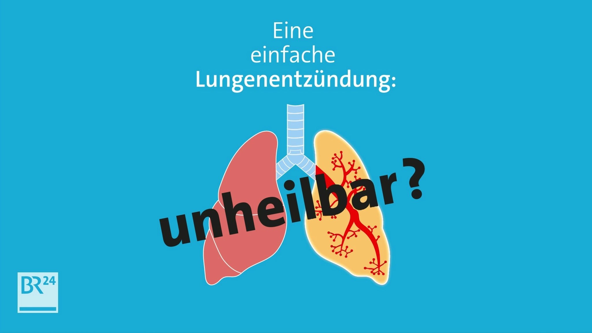 #fragBR24💡 Antibiotika-Resistenzen auf dem Vormarsch