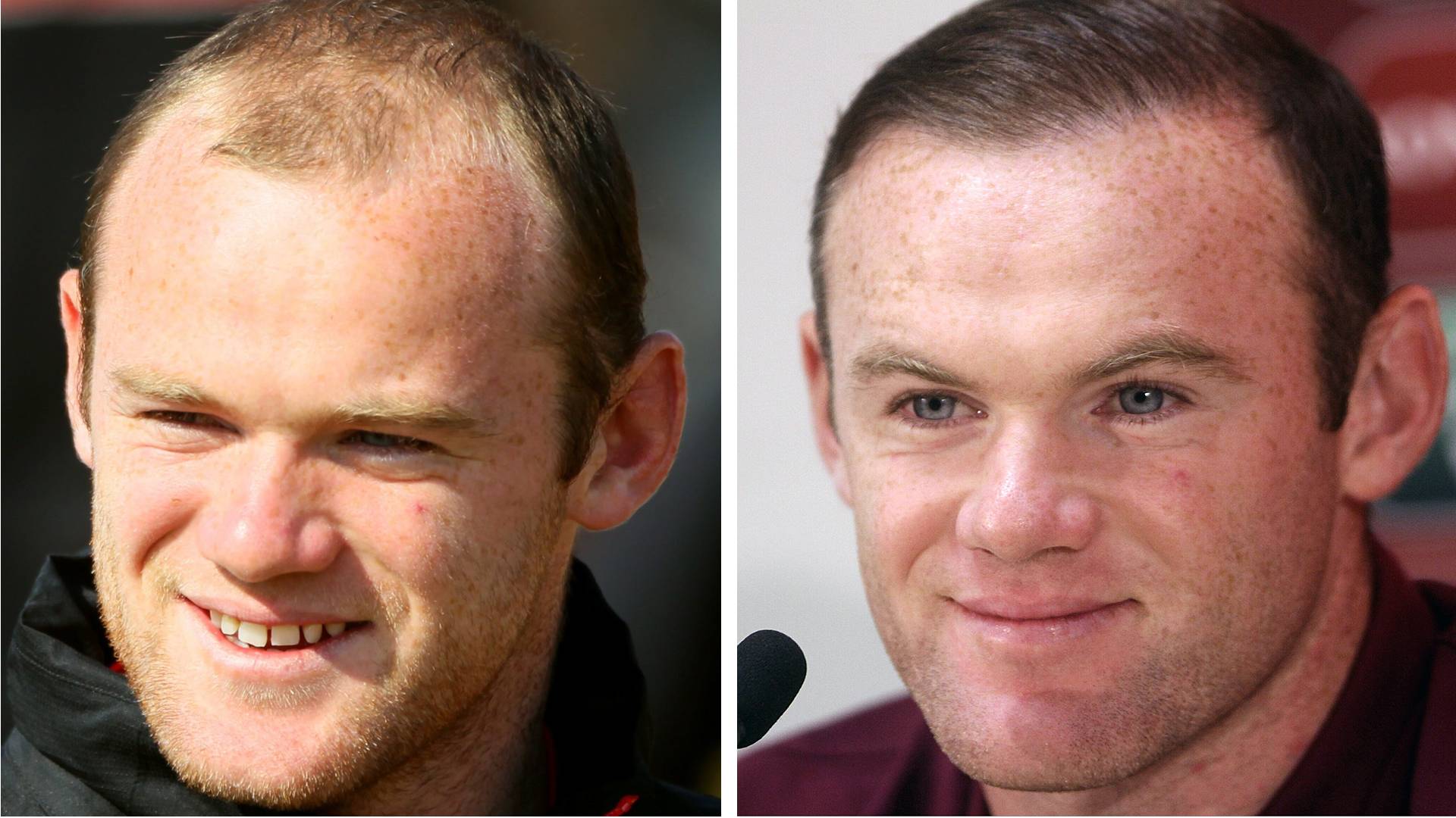 Christoph Metzelder Hat Jetzt Volleres Haar Haartransplantation Diese Promis Haben Die Frisur Getuned Bayern 3