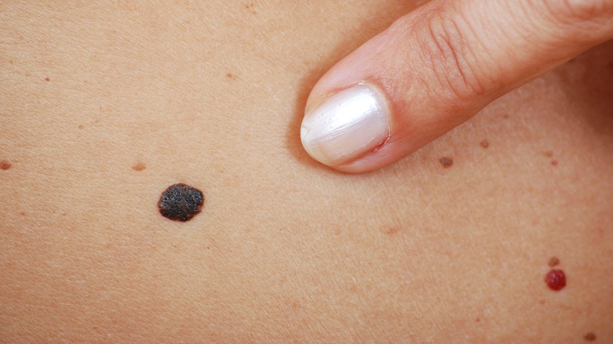 Immer mehr Menschen wegen Hautkrebs im Krankenhaus