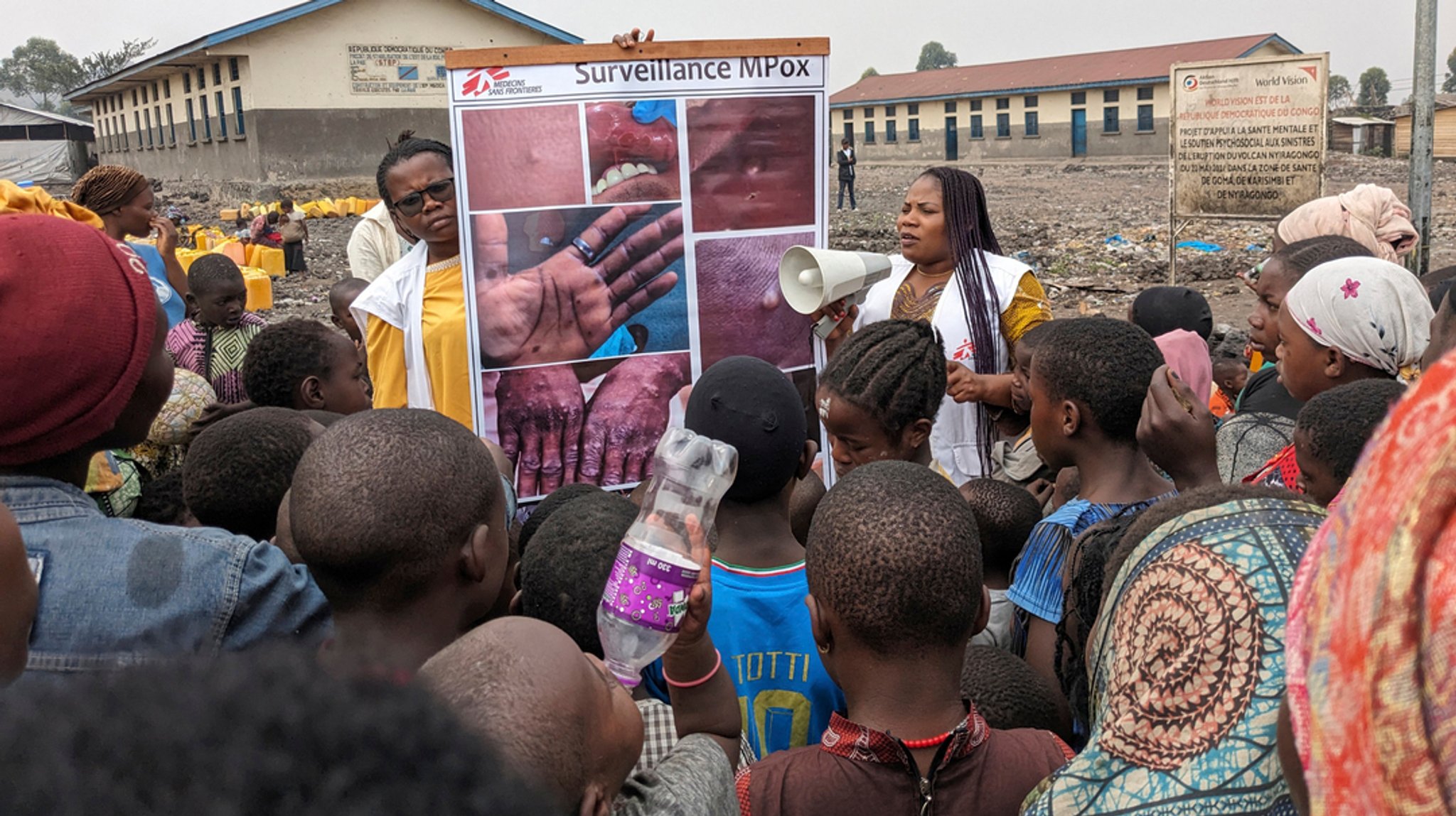 In Afrika breitet sich aktuell das Mpox-Virus aus