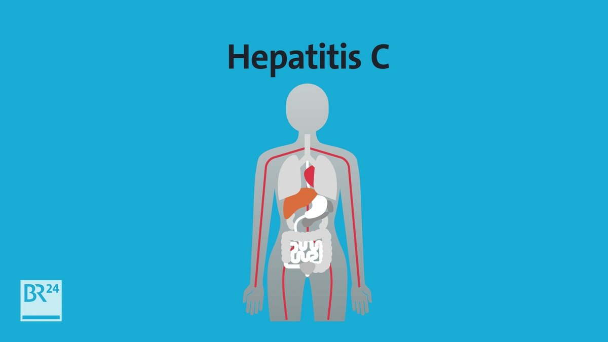 Was ist Hepatitis C?