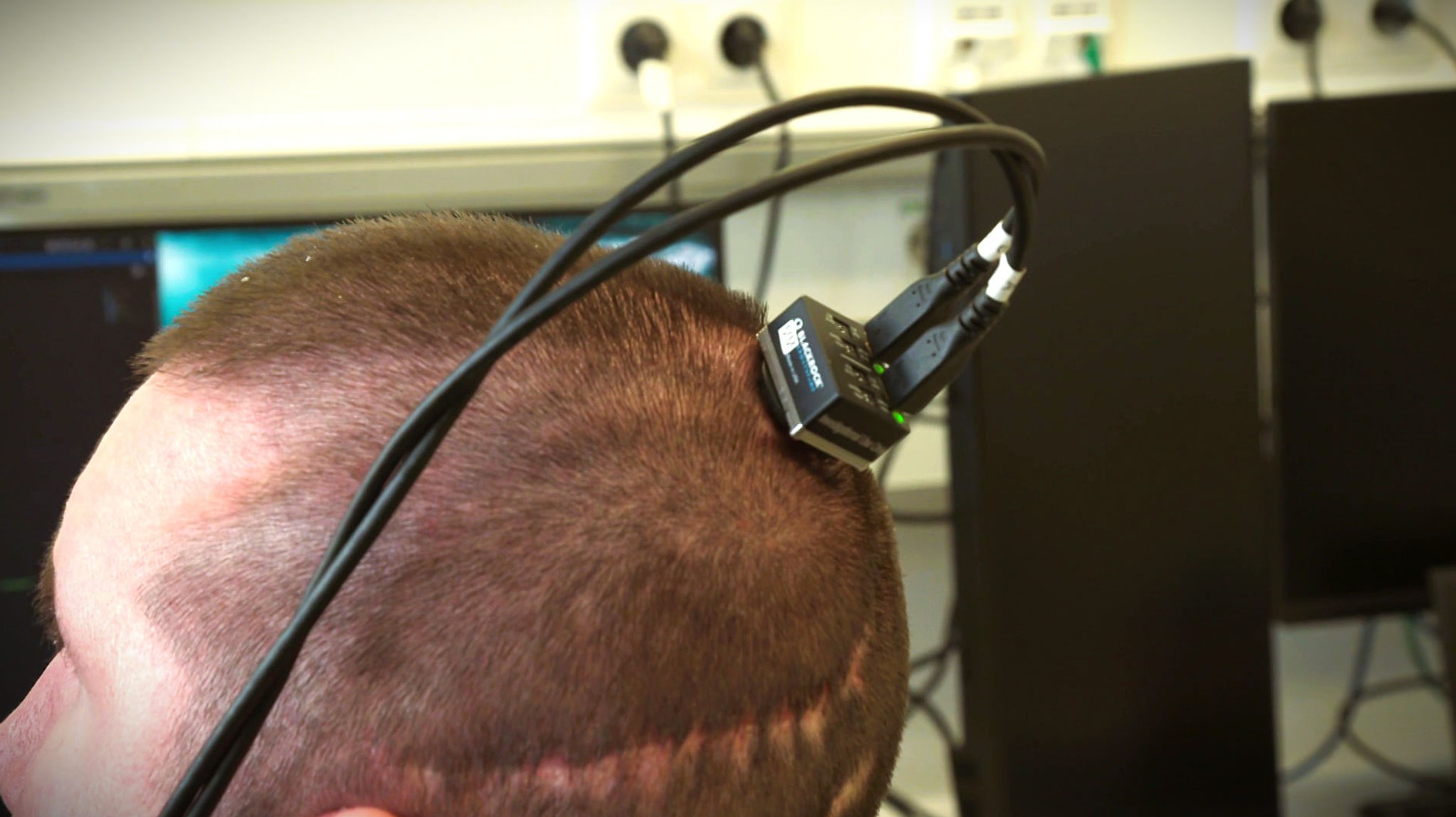 KI-Chip-im Gehirn bei Querschnittlähmung