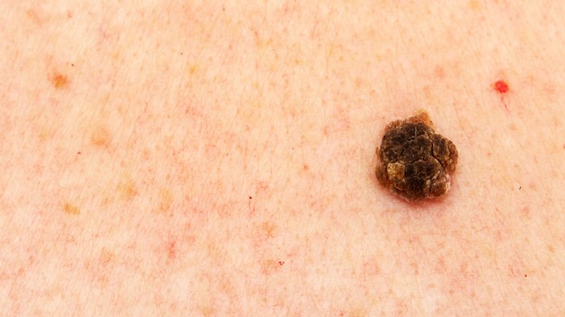 Ein schwarzer, schuppiger und dunkler Fleck auf der Haut | Bild: stock.adobe.com/Milan Lipowski Ein schwarzer, schuppiger und dunkler Fleck auf der Haut