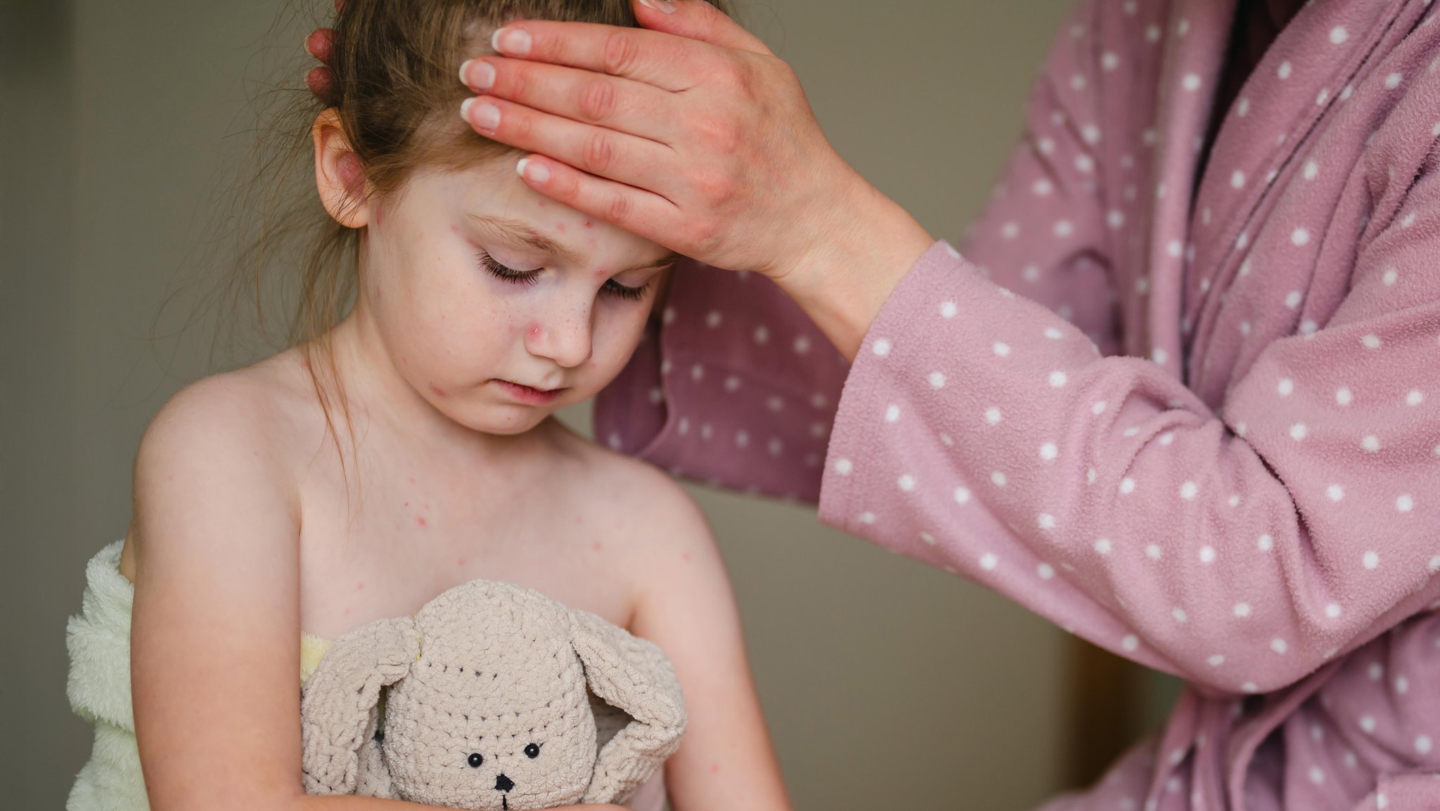 Kinderkrankheiten sind nicht harmlos. Im  Bild: Kind mit Windpocken