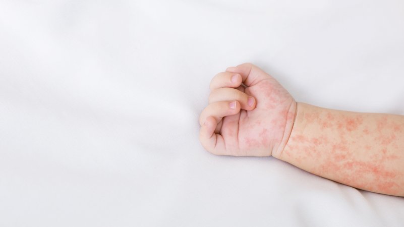 Masernerkrankung bei einem Neugeborenen mit den typischen roten Hautflecken auf der Innenseite von Hand und Unterarm. | Bild: BR Bild / stock.adobe.com Masernerkrankung bei einem Neugeborenen mit den typischen roten Hautflecken auf der Innenseite von Hand und Unterarm.
