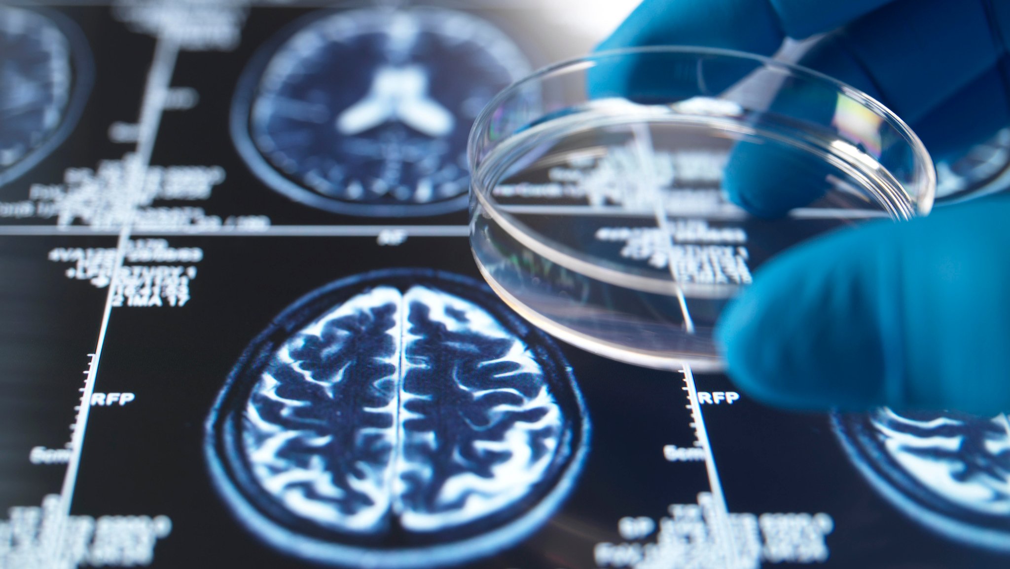 Das 3D-Hirngewebemodell eines Münchner Teams bildet Alzheimer-typische Veränderungen ab und soll künftig bei Wirkstofftests helfen.
