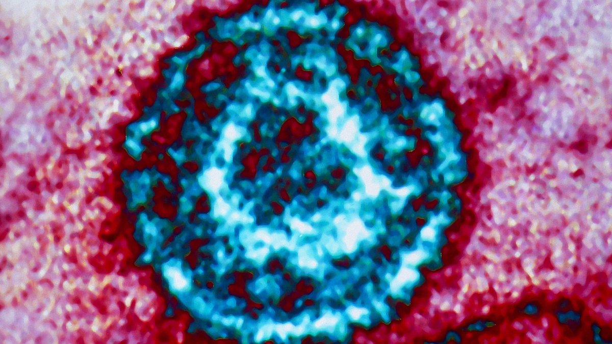 Unterschätzter Erreger: das Epstein-Barr-Virus 
