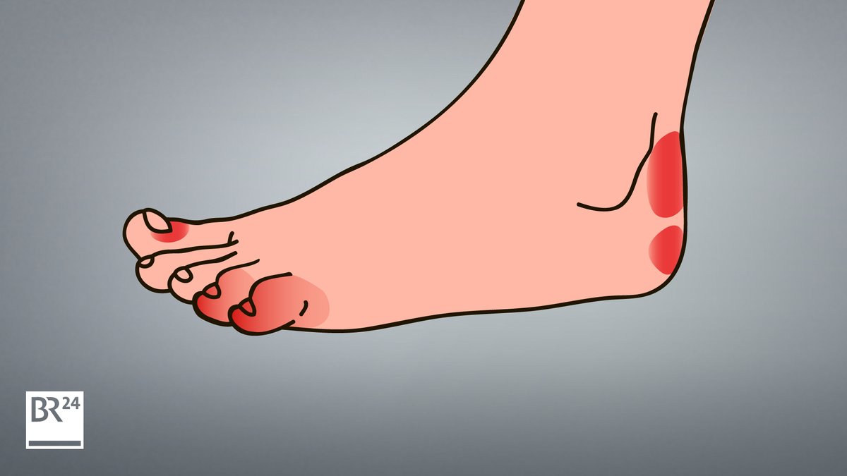 Schwellungen an Zehen, Fußsohlen, Fersen, Fingern oder Gliedmaßen: Spätfolgen einer Coronavirus-Infektion?