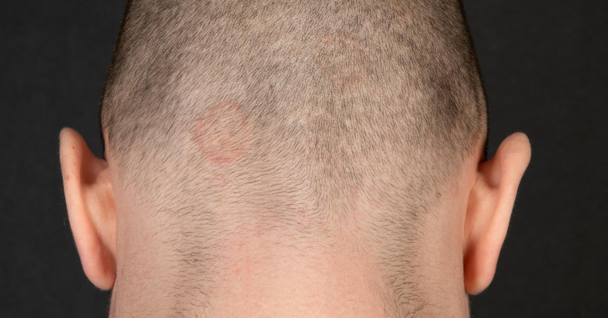 Ringelflechte am Hinterkopf eines Mannes