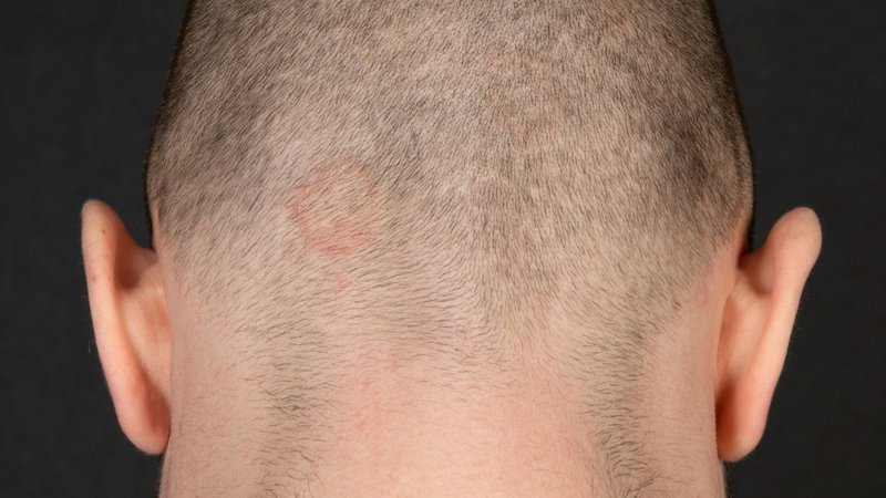 Ringelflechte am Hinterkopf eines Mannes | Bild: Uniklinik Erlangen Ringelflechte am Hinterkopf eines Mannes