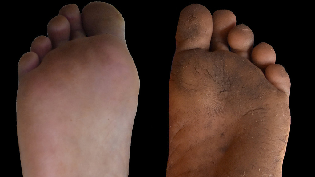 Hornhaut (rechts) wirkt sich beim Gehen nicht nachteilig aus, im Gegenteil. Wissenschaftler empfehlen deshalb Schuhe mit dünnen, starren Sohlen.