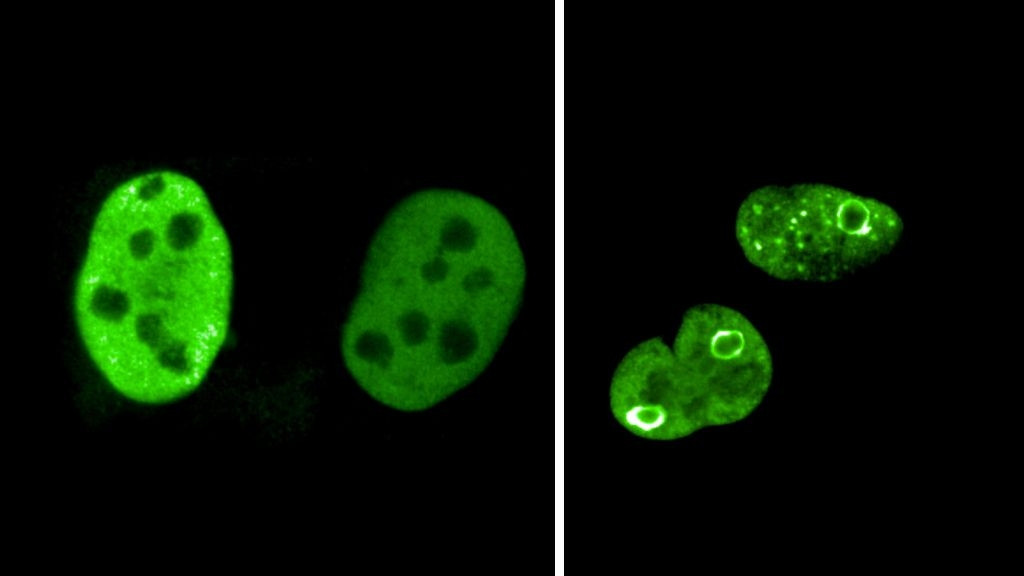 MYC-Proteine sind in dieser Abbildung grün gefärbt. In normal wachsenden Zellen sind sie gleichmäßig im Zellkern verteilt (links). In vielfältigen Stress-Situationen, wie sie in Krebszellen vorkommen, lagern sie sich um, bilden kugelartige Strukturen und umgeben damit besonders gefährdete Abschnitte des Genoms.
