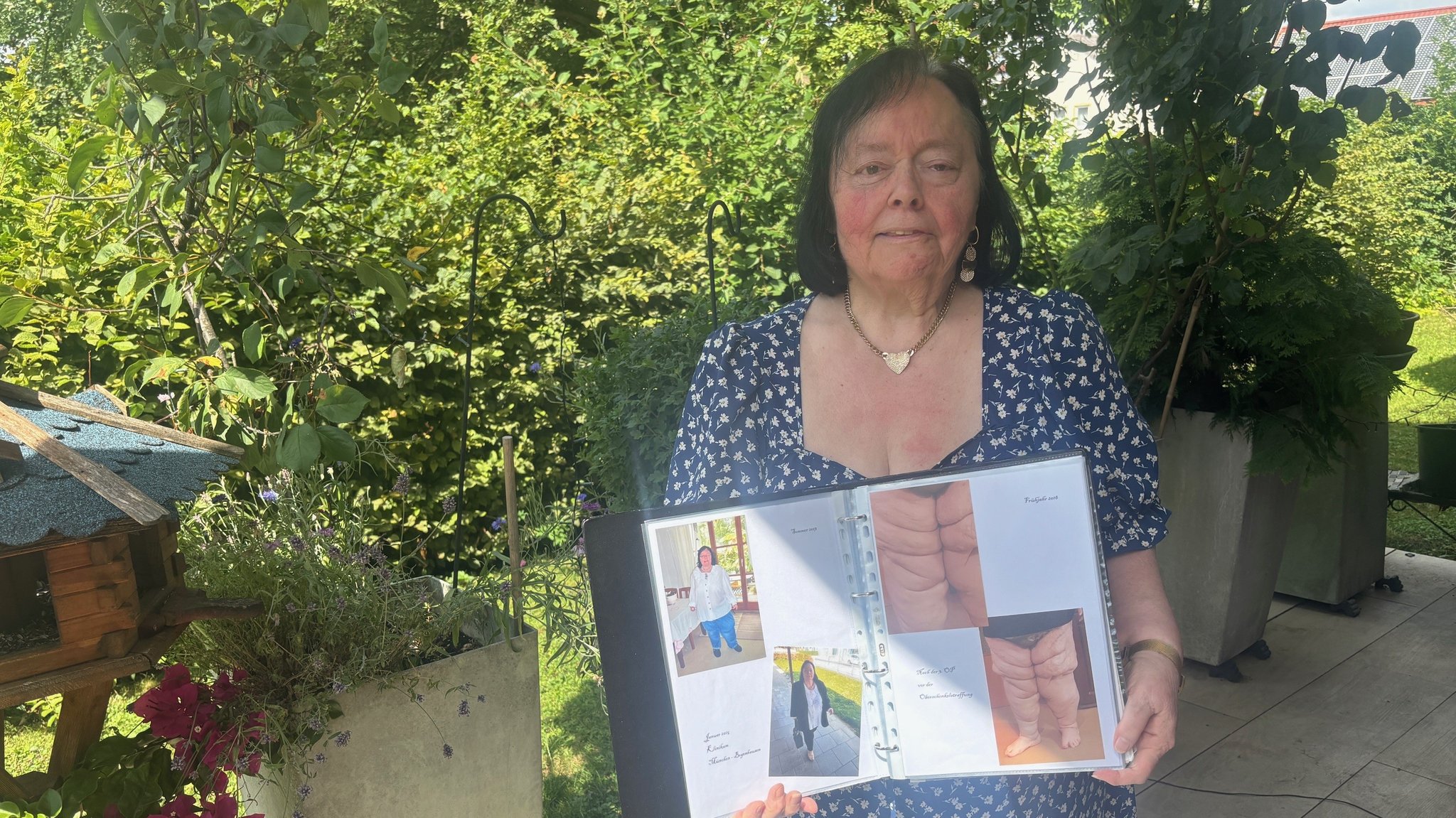 Lipödem Patientin Marieluise Biesenbach aus Lauingen zeigt Fotos, wie sie ausgesehen hat, vor ihren zahlreichen Operationen. | Bild: BR/ Judith Zacher Lipödem Patientin Marieluise Biesenbach aus Lauingen zeigt Fotos, wie sie ausgesehen hat, vor ihren zahlreichen Operationen.