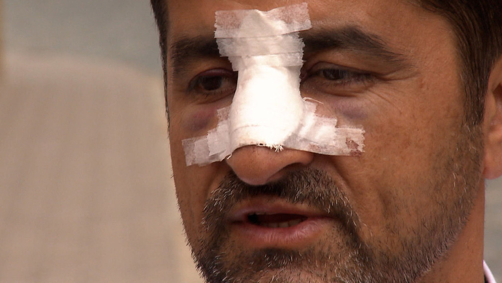 Halil Tasdelen trägt einen Nasengips. 