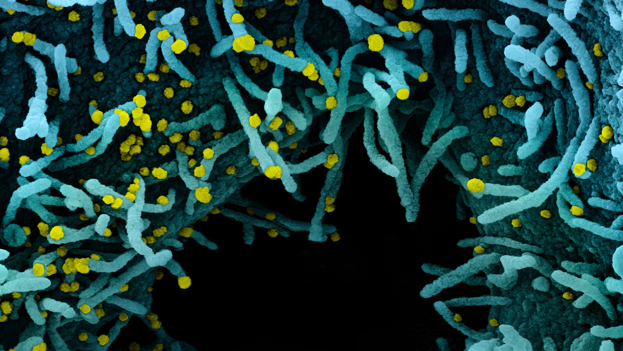 Blick in eine Zelle, die stark von Partikeln des Coronavirus befallen ist. Die Aufnahme stammt aus einem Elektronenmikroskop und wurde koloriert (Archivbild) | Bild: picture alliance / BSIP|NIH-NIAID / IMAGE POINT FR Blick in eine Zelle, die stark von Partikeln des Coronavirus befallen ist. Die Aufnahme stammt aus einem Elektronenmikroskop und wurde koloriert (Archivbild)