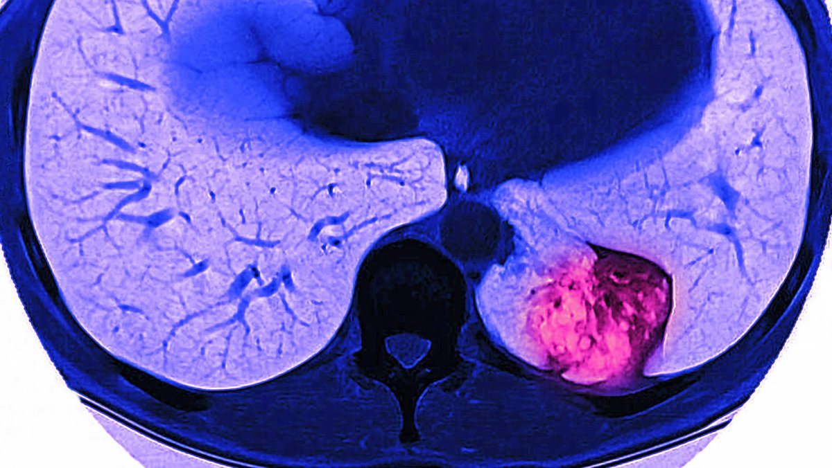 Auf dieser MRT-Aufnahme ist ein Tumor im Lungenflügel zu erkennen.