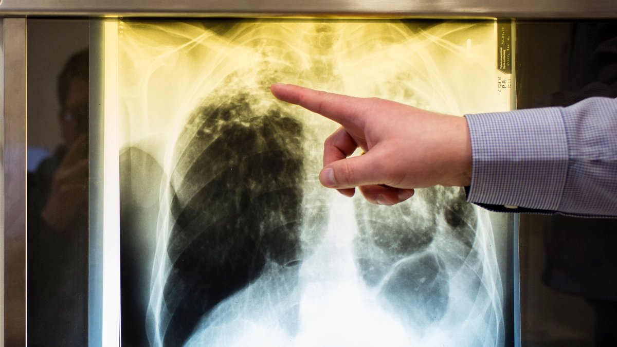 Ein Arzt zeigt einen Tuberkulose-Fall anhand eines Röntgenbildes (Archivbild)