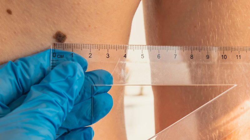 Eine Hand im blauen Gummihandschuh hält ein Lineal und misst ein Muttermal auf der Haut | Bild: picture alliance / Zoonar | Anastasiia Yanishevska Eine Hand im blauen Gummihandschuh hält ein Lineal und misst ein Muttermal auf der Haut