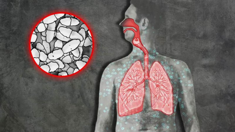 Grafische Darstellung von Lunge und Pneumokokken