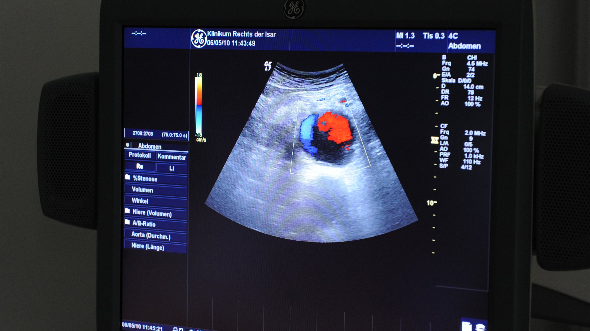 Ein Bildschirm in einer Klinik für Gefäßchirurgie zeigt im Ultraschall die erweiterte Aorta eines Patienten.