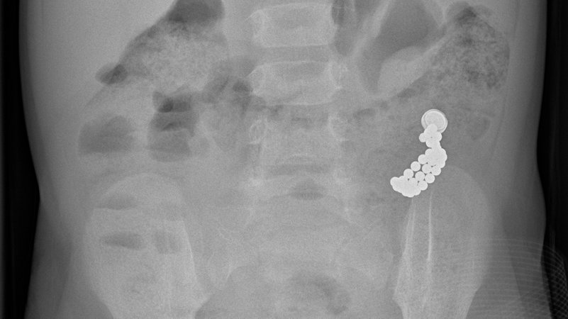 Magnete im Darm: Im Röntgenbild ist die Ansammlung der 32 Magnetkugeln und der Knopfzelle im Dünndarm des Kindes deutlich zu erkennen.