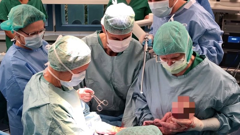 Ein Ärzteteam des Universitätsklinikums Tübingen im Mai 2019  bei der Geburt eines Babys von einer Frau mit einer transplantierten Gebärmutter.