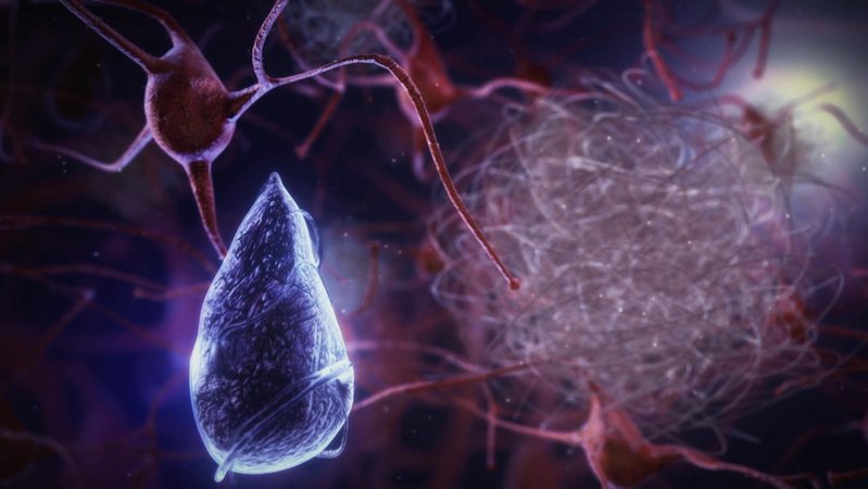 Nervenzelle mit Alzheimer-Anzeichen