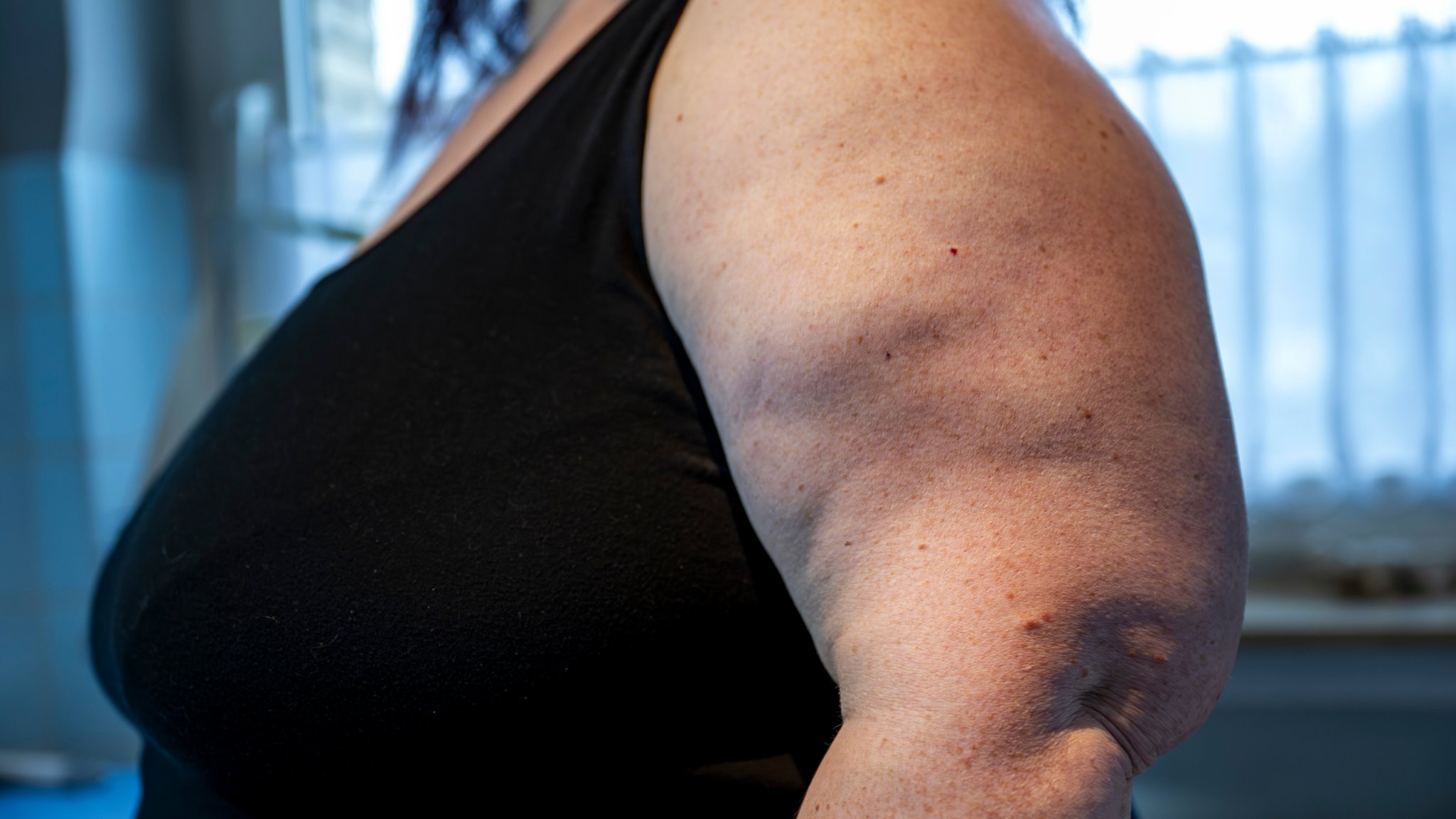 Eine Frau steht in ihrem Badezimmer und zeigt ihre Oberarme. Die Frau leidet an Lipödem. | Bild: picture alliance/dpa | David Inderlied Eine Frau steht in ihrem Badezimmer und zeigt ihre Oberarme. Die Frau leidet an Lipödem.