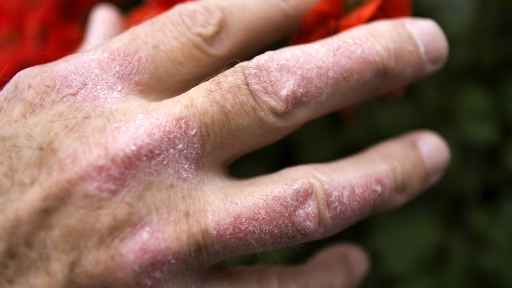 Schuppenflechte (Psoriasis) sind an der Hand eines Mannes zu sehen. Neue Medikamente ermöglichen ein beschwerdefreies Leben.