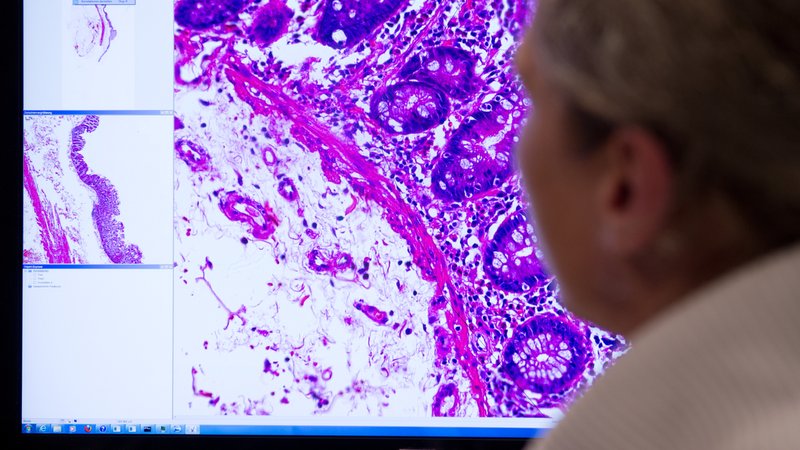 Ein Mitarbeiter der Pathologie an der Charite in Berlin schaut auf ein Monitorbild, das krankhaft verändertes Gewebe zeigt. | Bild: pa / dpa | Franziska Gabbert Ein Mitarbeiter der Pathologie an der Charite in Berlin schaut auf ein Monitorbild, das krankhaft verändertes Gewebe zeigt.