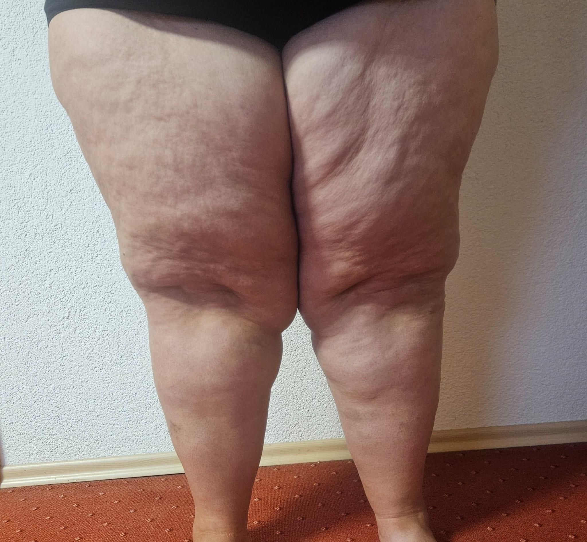 Die Oberschenkel einer jungen Frau mit Lipödem.