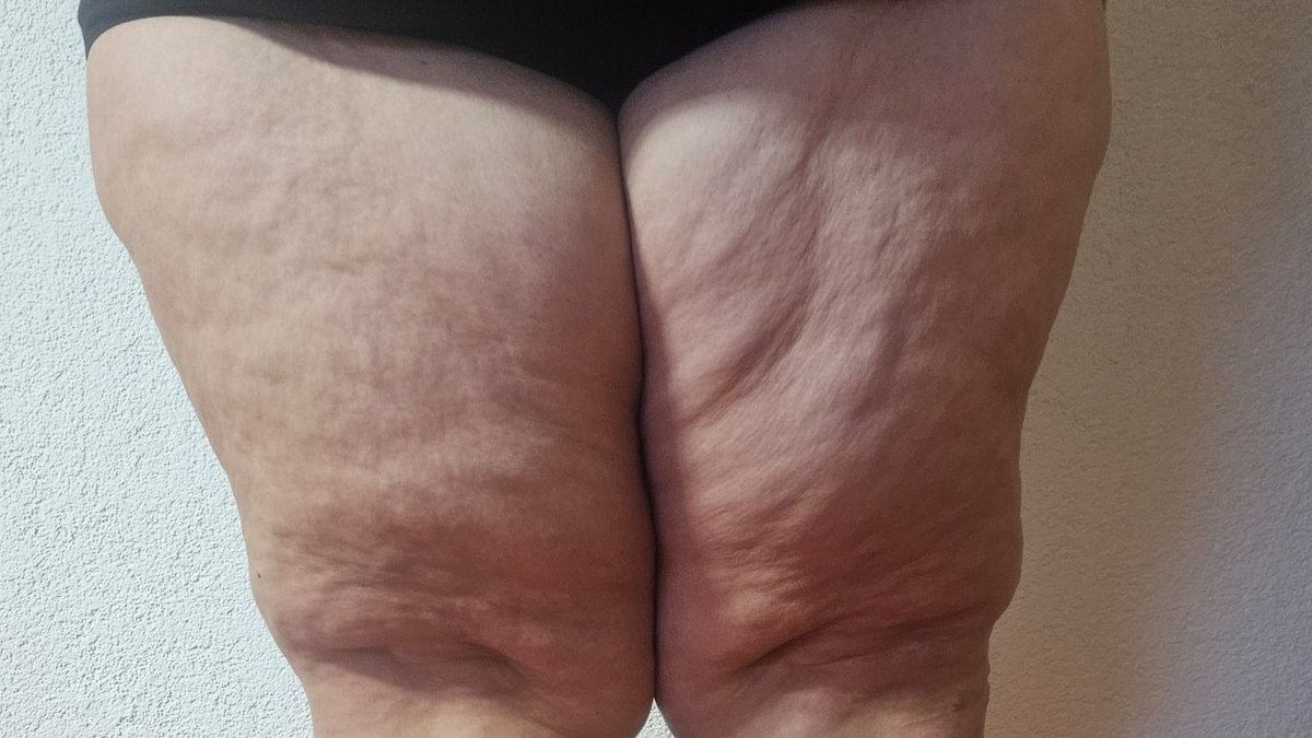 Lipödem: Auch viele junge Frauen betroffen