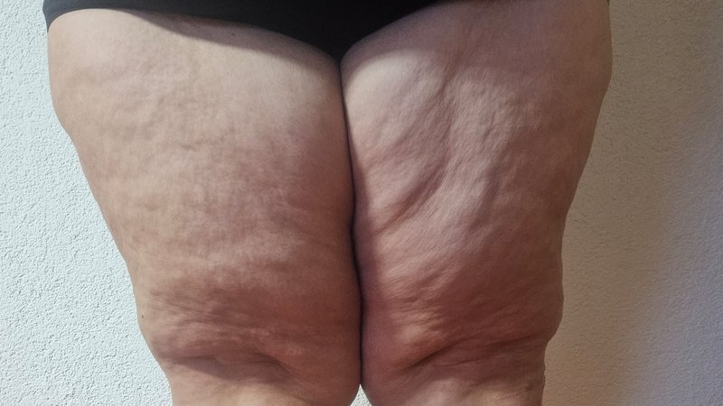 Die Oberschenkel einer jungen Frau mit Lipödem. | Bild: Privat Die Oberschenkel einer jungen Frau mit Lipödem.