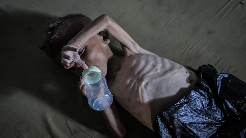 Unterernährtes Kind in Gaza-Stadt | Bild: picture alliance / Anadolu | Ahmed Jihad Ibrahim Al-arini Unterernährtes Kind in Gaza-Stadt