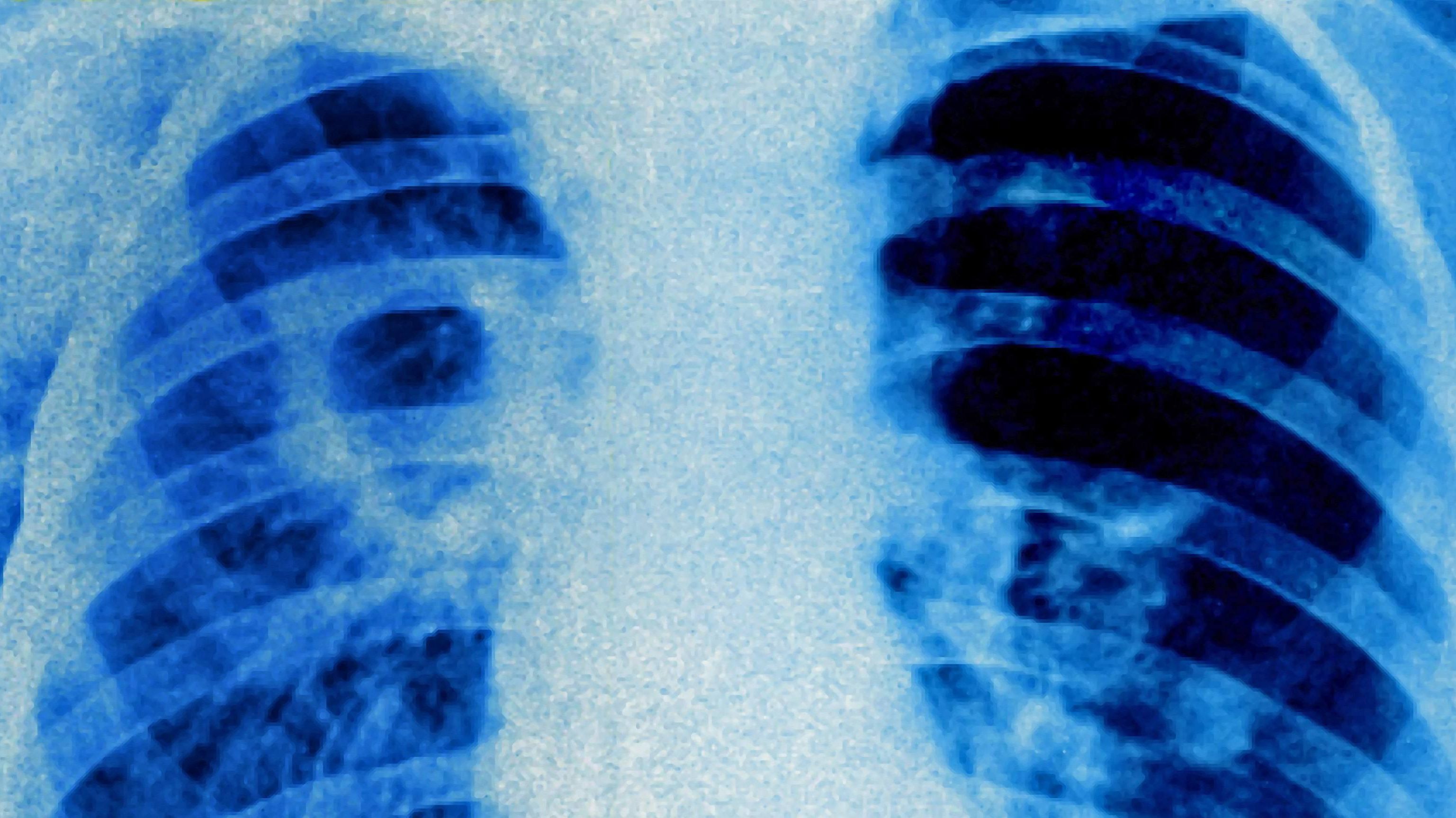 Landratsamt Bamberg Meldet Tuberkulose Fall Br24