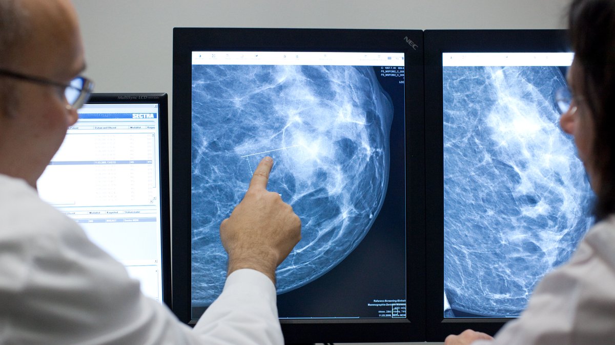 Mammographie einer Brust mit auffälligen Veränderungen