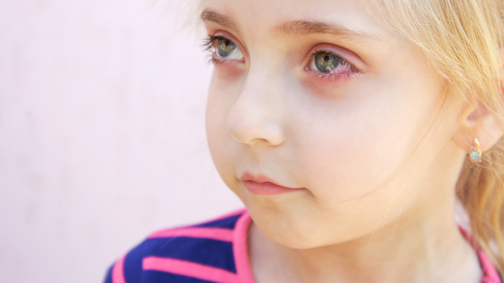 Kind mit entzündeten Augen - Symptome wie nach einer Adenovirus-Infektion