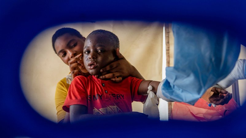 Die neue Variante des Mpox-Virus verbreitet sich derzeit vor allem in der Demokratischen Republik Kongo. | Bild: dpa-Bildfunk/Moses Sawasawa Die neue Variante des Mpox-Virus verbreitet sich derzeit vor allem in der Demokratischen Republik Kongo.