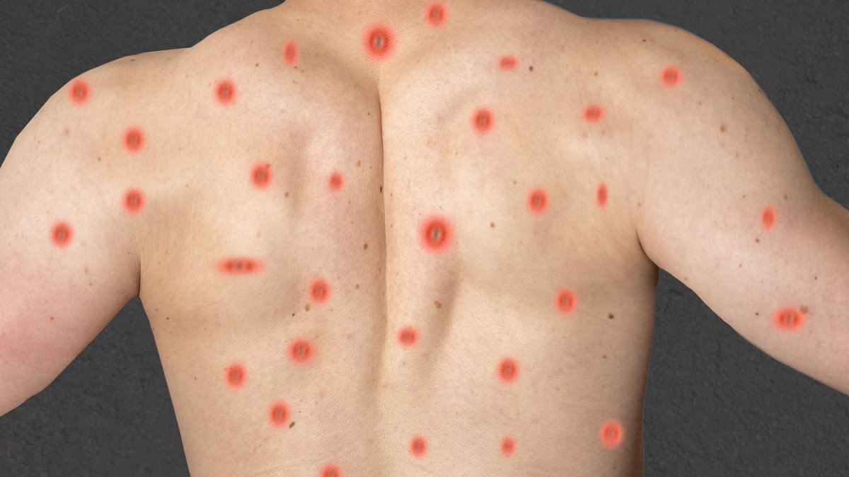 Fotomontage von Affenpocken beziehungsweise Mpox auf dem Rücken eines jungen Mannes