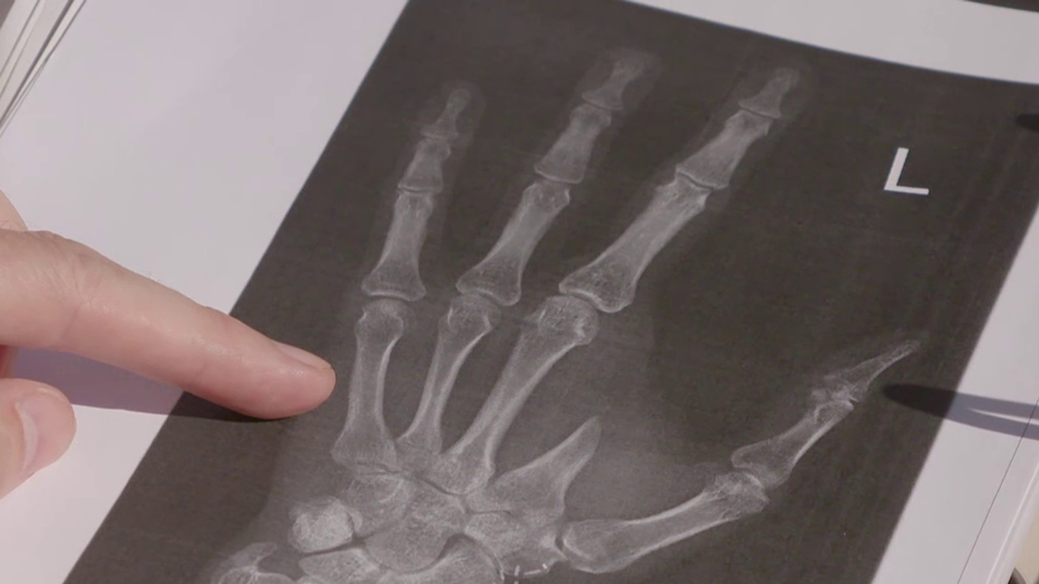 Ein Mann zeigt mit einem Finger auf ein Röntgenbild, auf dem eine Linke Hand mit nur vier Fingern zu sehen ist.