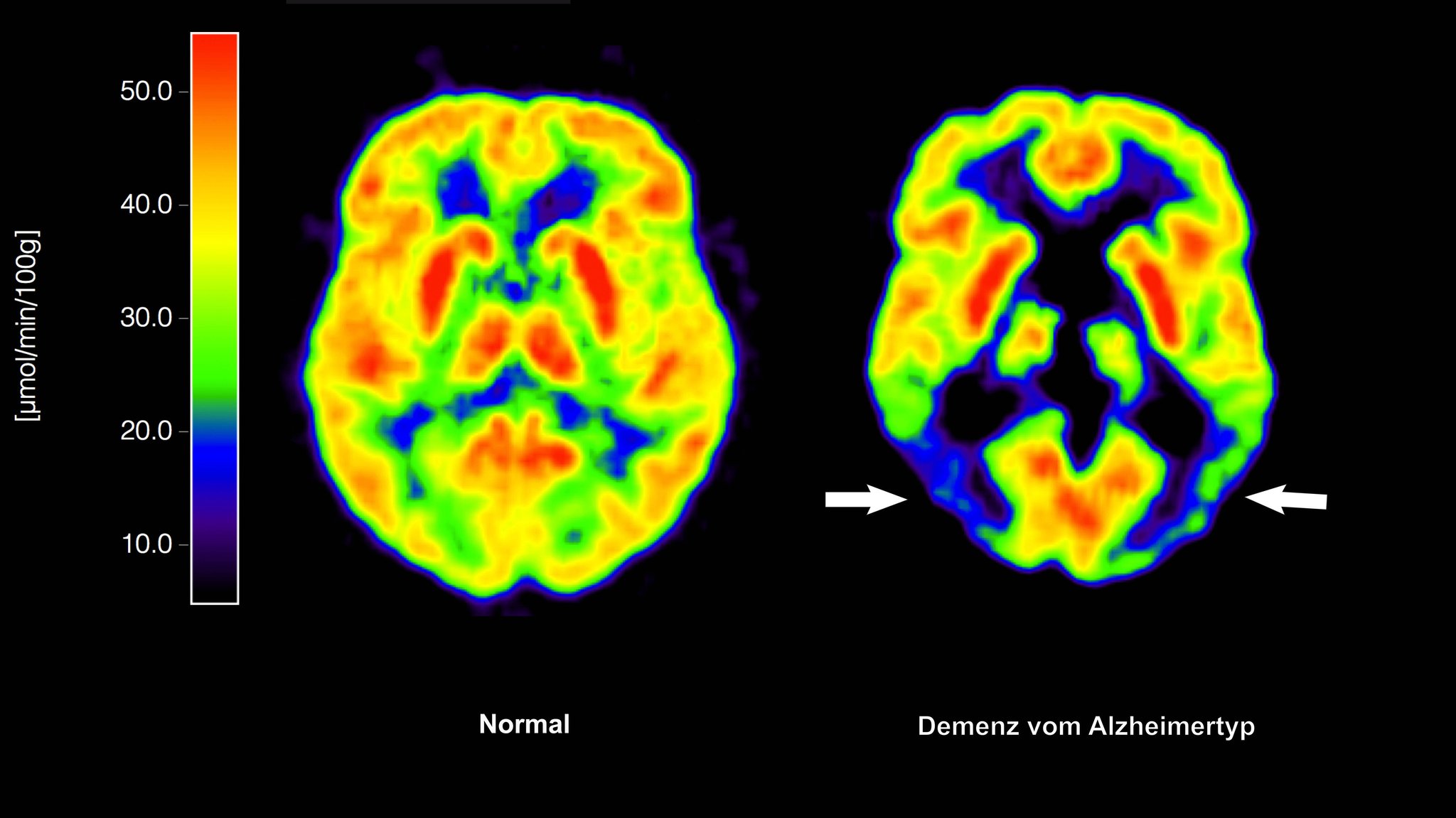 Blutdruck- und Cholesterinsenker verringern Risiko für Demenz