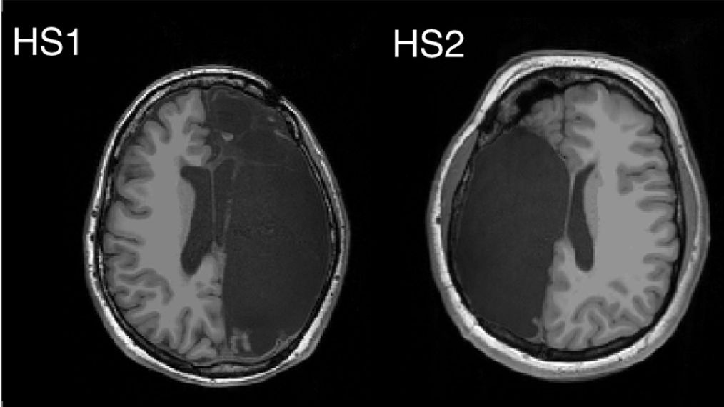Warum Ein Halbes Gehirn Mitunter Volle Leistung Bringt Br24
