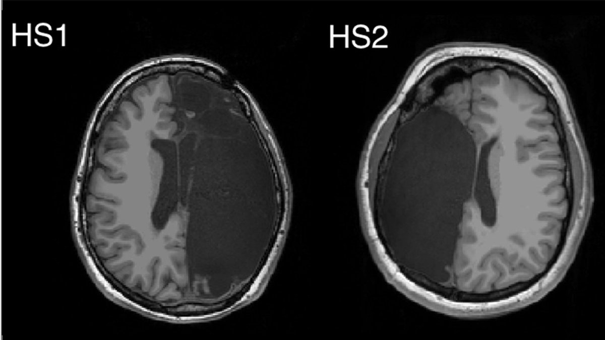 Funktionelle MRT-Aufnahme von zwei der sechs Probanden mit linker bzw. rechter neurochirurgischen Entfernung einer Gehirnhälfte. 